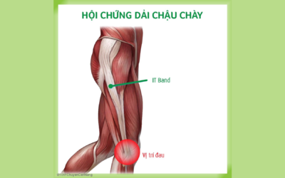 Hội chứng Dải Chậu Chày (Iliotibial Band Syndrome)