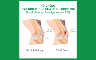 Hội chứng đau khớp xương bánh chè – xương đùi (Patellofemoral Pain Syndrome – PFS)