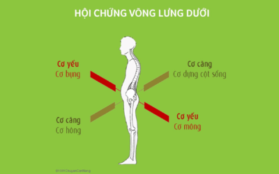 Hội chứng võng lưng dưới